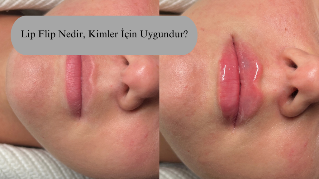 Galata’da Doğal Dudak Estetiği: Lip Flip Nedir, Kimler İçin Uygundur?